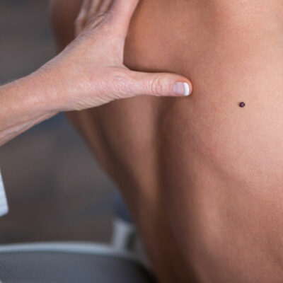 Risk Factors and Prevention Tips for Melanoma