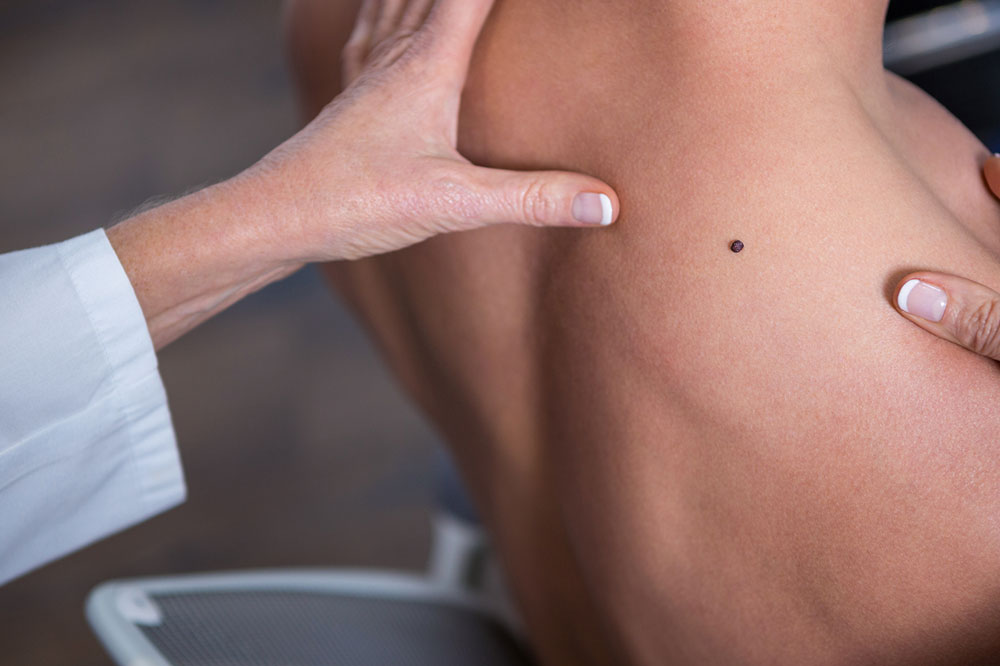 Risk Factors and Prevention Tips for Melanoma