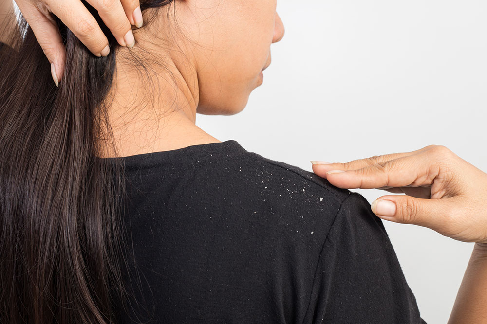 6 Natural Remedies for a Dandruff-Free Scalp